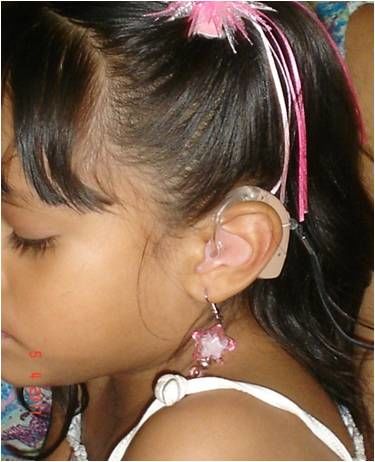 Una adaptación BTE en una nena
